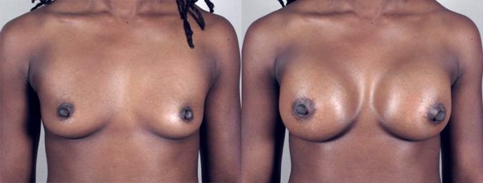 Breast Augmentation Case 366 Before & After View #1 | Paramus, New Jersey | Parker Center for Plastic Surgery