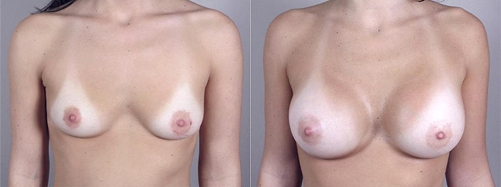 Breast Augmentation Case 367 Before & After View #1 | Paramus, New Jersey | Parker Center for Plastic Surgery