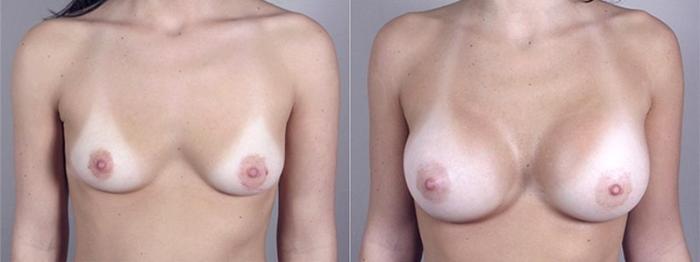 Breast Augmentation Case 367 Before & After View #1 | Paramus, New Jersey | Parker Center for Plastic Surgery