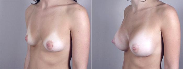 Breast Augmentation Case 367 Before & After View #2 | Paramus, New Jersey | Parker Center for Plastic Surgery