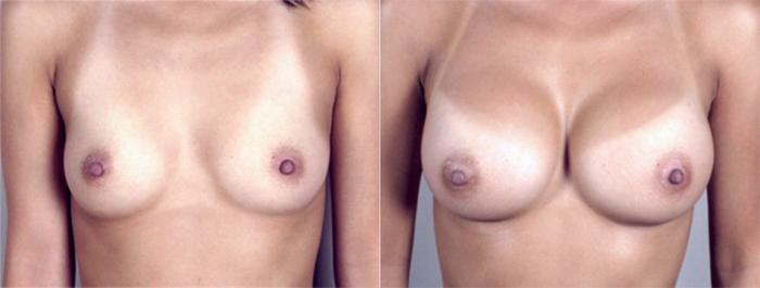 Breast Augmentation Case 369 Before & After View #1 | Paramus, New Jersey | Parker Center for Plastic Surgery