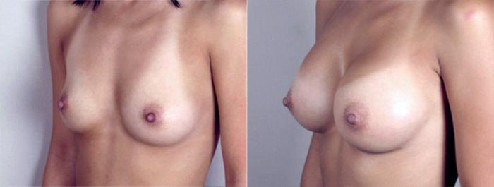 Breast Augmentation Case 369 Before & After View #2 | Paramus, New Jersey | Parker Center for Plastic Surgery