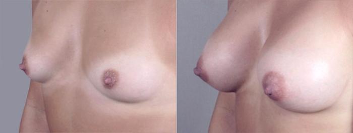 Breast Augmentation Case 370 Before & After View #2 | Paramus, New Jersey | Parker Center for Plastic Surgery