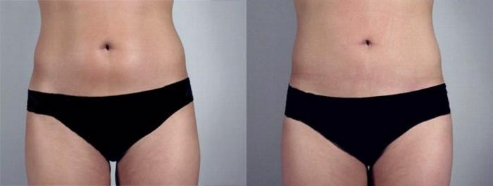 Breast Augmentation Case 370 Before & After View #3 | Paramus, New Jersey | Parker Center for Plastic Surgery