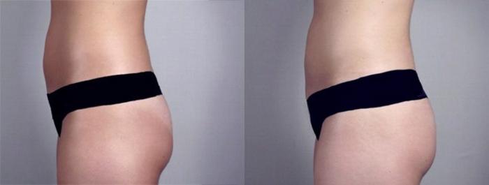 Breast Augmentation Case 370 Before & After View #4 | Paramus, New Jersey | Parker Center for Plastic Surgery