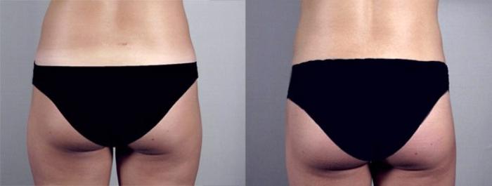 Breast Augmentation Case 370 Before & After View #5 | Paramus, New Jersey | Parker Center for Plastic Surgery