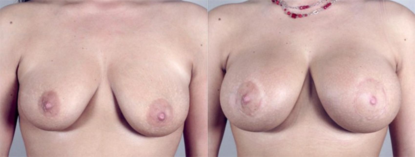 Breast Augmentation Case 371 Before & After View #1 | Paramus, New Jersey | Parker Center for Plastic Surgery