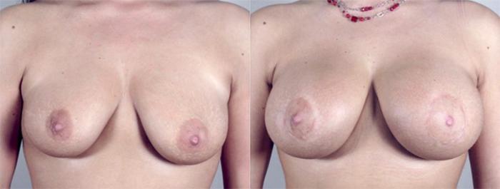 Breast Augmentation Case 371 Before & After View #1 | Paramus, New Jersey | Parker Center for Plastic Surgery
