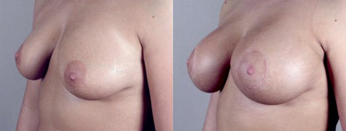 Breast Augmentation Case 371 Before & After View #2 | Paramus, New Jersey | Parker Center for Plastic Surgery