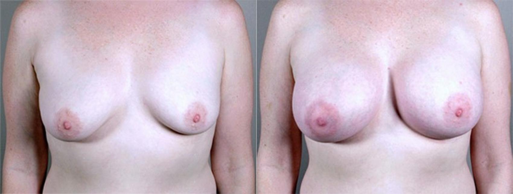 Breast Augmentation Case 372 Before & After View #1 | Paramus, New Jersey | Parker Center for Plastic Surgery