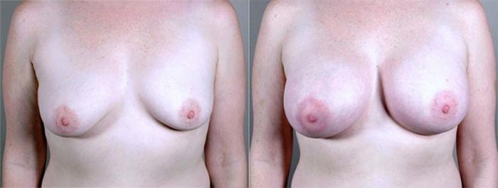 Breast Augmentation Case 372 Before & After View #1 | Paramus, New Jersey | Parker Center for Plastic Surgery