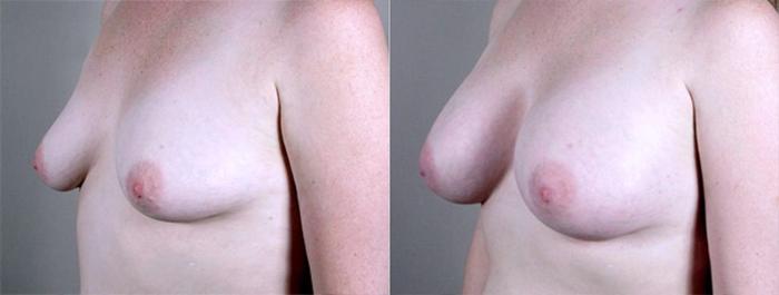Breast Augmentation Case 372 Before & After View #2 | Paramus, New Jersey | Parker Center for Plastic Surgery