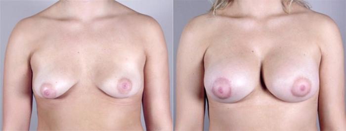 Breast Augmentation Case 373 Before & After View #1 | Paramus, New Jersey | Parker Center for Plastic Surgery