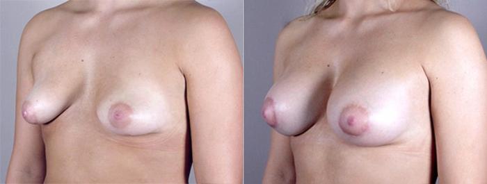 Breast Augmentation Case 373 Before & After View #2 | Paramus, New Jersey | Parker Center for Plastic Surgery