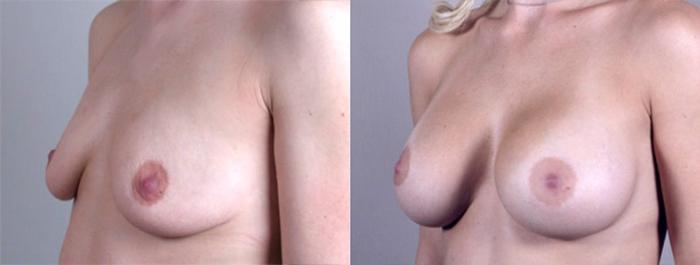 Breast Augmentation Case 374 Before & After View #2 | Paramus, New Jersey | Parker Center for Plastic Surgery