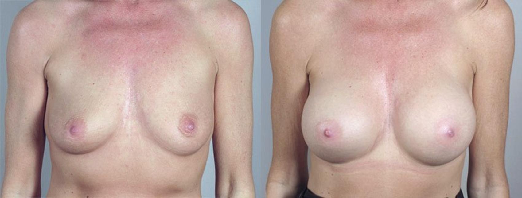 Breast Augmentation Case 375 Before & After View #1 | Paramus, New Jersey | Parker Center for Plastic Surgery