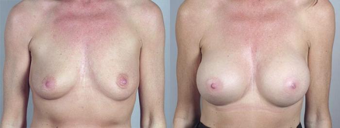 Breast Augmentation Case 375 Before & After View #1 | Paramus, New Jersey | Parker Center for Plastic Surgery