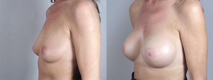 Breast Augmentation Case 375 Before & After View #2 | Paramus, New Jersey | Parker Center for Plastic Surgery