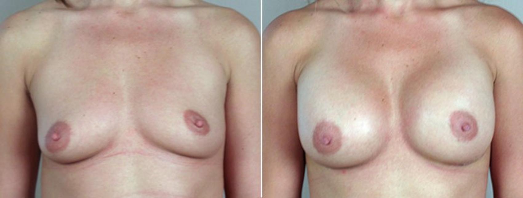Breast Augmentation Case 377 Before & After View #1 | Paramus, New Jersey | Parker Center for Plastic Surgery