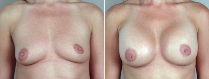 Breast Augmentation Case 377 Before & After View #1 | Paramus, New Jersey | Parker Center for Plastic Surgery