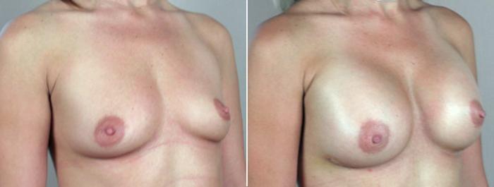 Breast Augmentation Case 377 Before & After View #2 | Paramus, New Jersey | Parker Center for Plastic Surgery