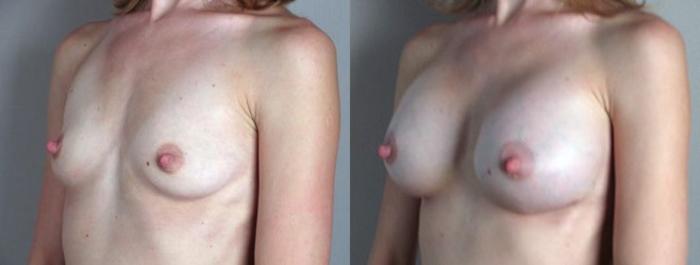 Breast Augmentation Case 378 Before & After View #2 | Paramus, New Jersey | Parker Center for Plastic Surgery