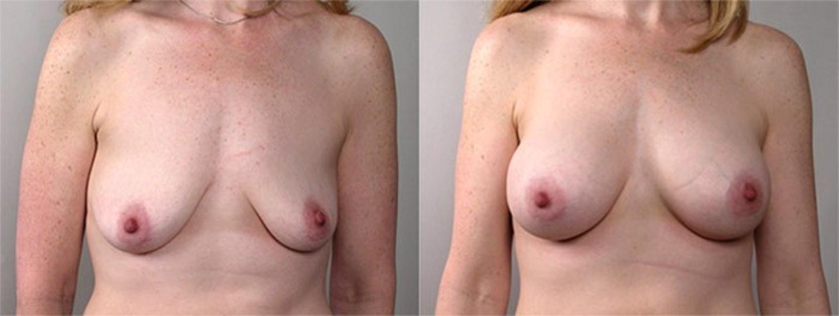Breast Augmentation Case 379 Before & After View #1 | Paramus, New Jersey | Parker Center for Plastic Surgery