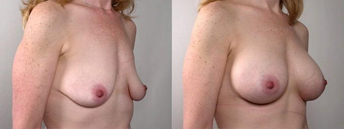 Breast Augmentation Case 379 Before & After View #2 | Paramus, New Jersey | Parker Center for Plastic Surgery