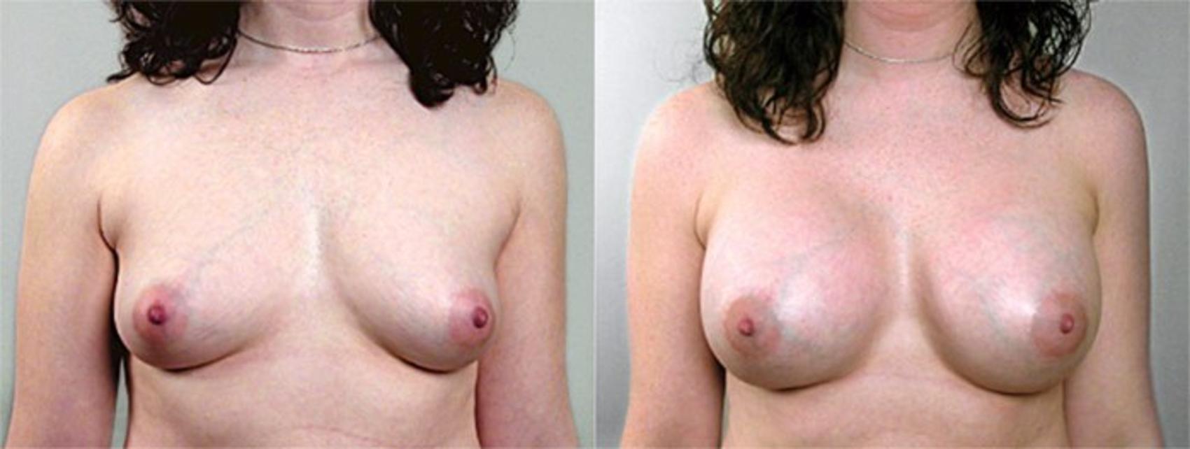 Breast Augmentation Case 380 Before & After View #1 | Paramus, New Jersey | Parker Center for Plastic Surgery
