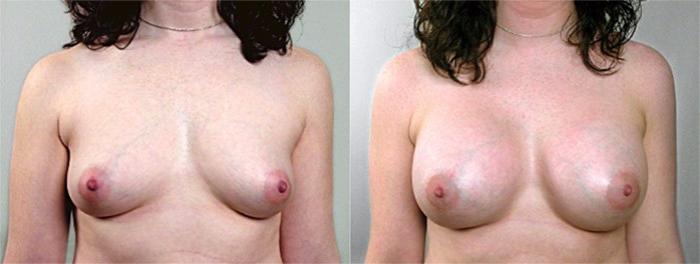 Breast Augmentation Case 380 Before & After View #1 | Paramus, New Jersey | Parker Center for Plastic Surgery