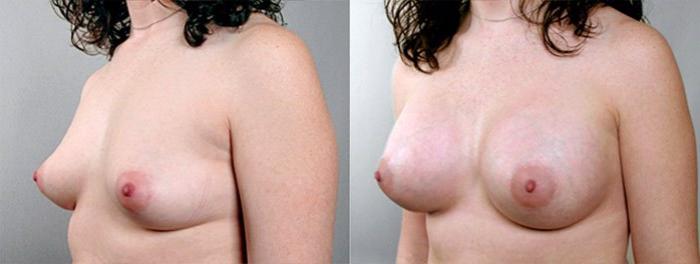 Breast Augmentation Case 380 Before & After View #2 | Paramus, New Jersey | Parker Center for Plastic Surgery
