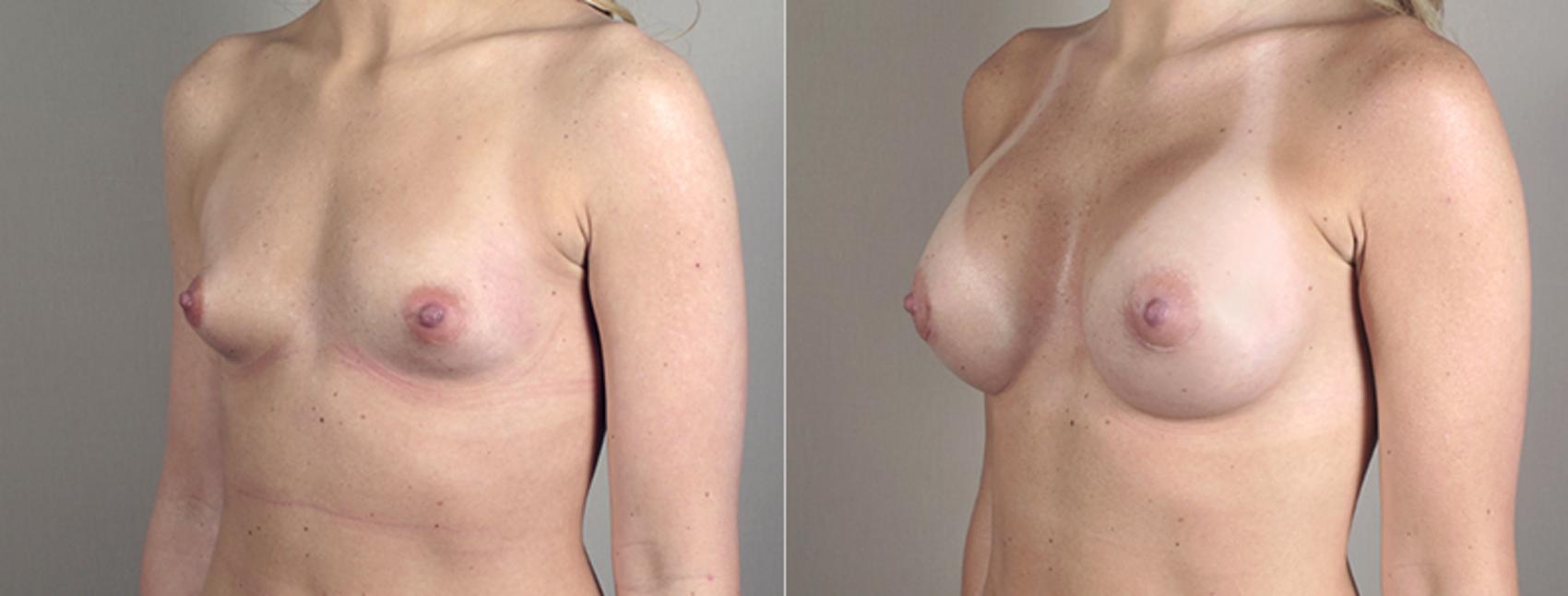 Breast Augmentation Case 385 Before & After View #2 | Paramus, New Jersey | Parker Center for Plastic Surgery