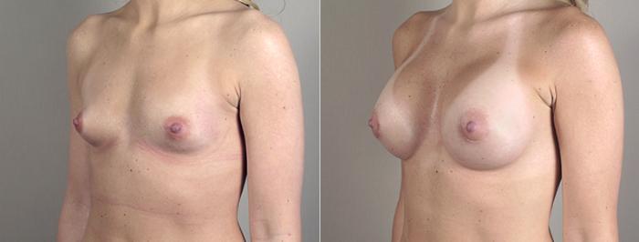 Breast Augmentation Case 385 Before & After View #2 | Paramus, New Jersey | Parker Center for Plastic Surgery
