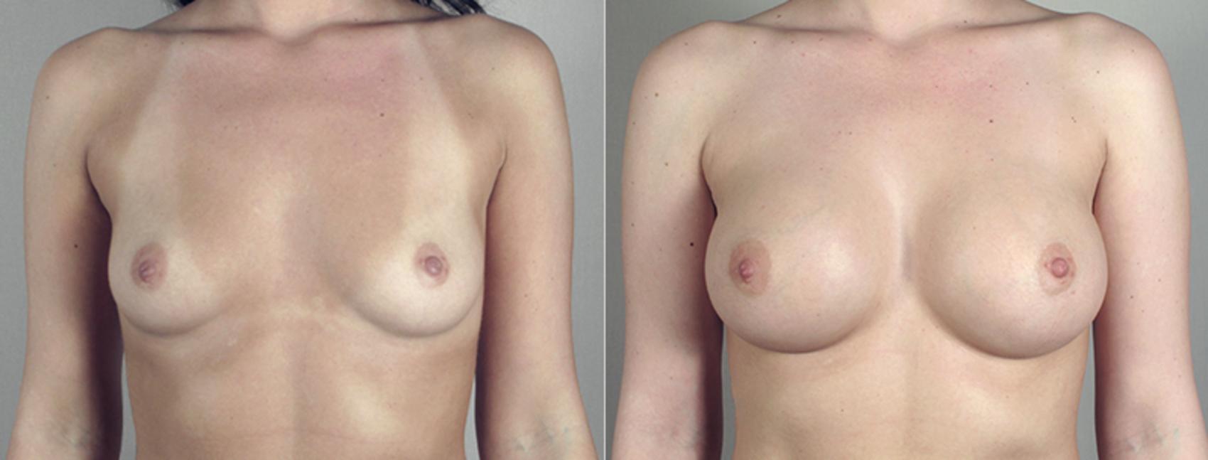 Breast Augmentation Case 386 Before & After View #1 | Paramus, New Jersey | Parker Center for Plastic Surgery