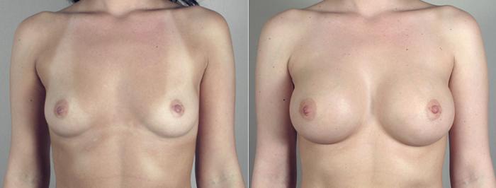 Breast Augmentation Case 386 Before & After View #1 | Paramus, New Jersey | Parker Center for Plastic Surgery