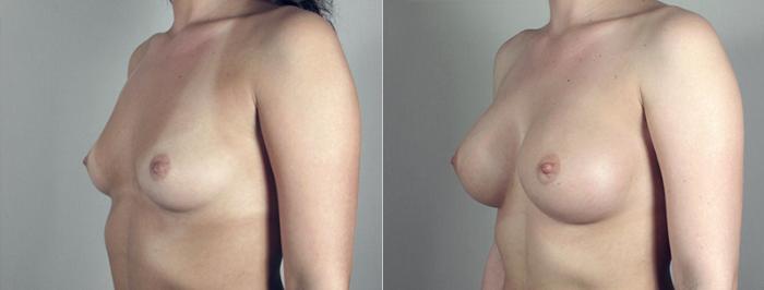 Breast Augmentation Case 386 Before & After View #2 | Paramus, New Jersey | Parker Center for Plastic Surgery