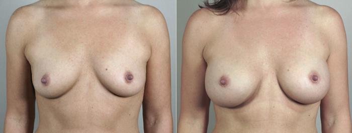 Breast Augmentation Case 387 Before & After View #1 | Paramus, New Jersey | Parker Center for Plastic Surgery