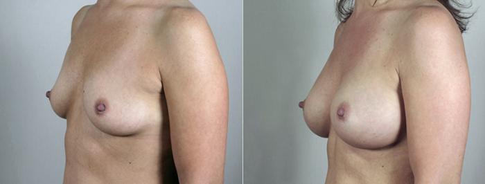 Breast Augmentation Case 387 Before & After View #2 | Paramus, New Jersey | Parker Center for Plastic Surgery