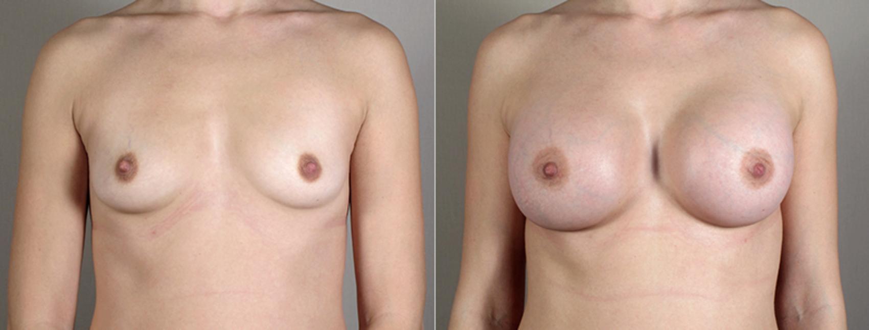 Breast Augmentation Case 389 Before & After View #1 | Paramus, New Jersey | Parker Center for Plastic Surgery