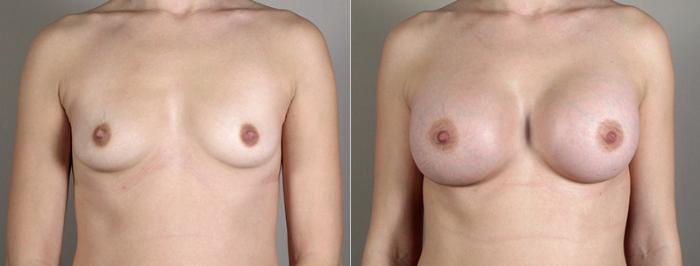 Breast Augmentation Case 389 Before & After View #1 | Paramus, New Jersey | Parker Center for Plastic Surgery
