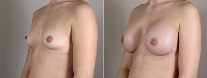 Breast Augmentation Case 389 Before & After View #2 | Paramus, New Jersey | Parker Center for Plastic Surgery