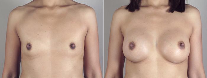 Breast Augmentation Case 390 Before & After View #1 | Paramus, New Jersey | Parker Center for Plastic Surgery