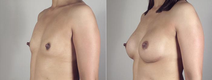 Breast Augmentation Case 390 Before & After View #2 | Paramus, New Jersey | Parker Center for Plastic Surgery