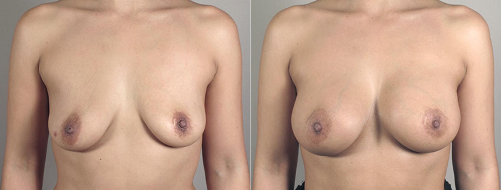 Breast Augmentation Case 391 Before & After View #1 | Paramus, New Jersey | Parker Center for Plastic Surgery