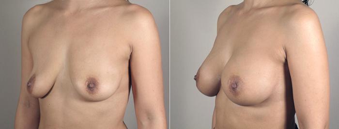 Breast Augmentation Case 391 Before & After View #2 | Paramus, New Jersey | Parker Center for Plastic Surgery