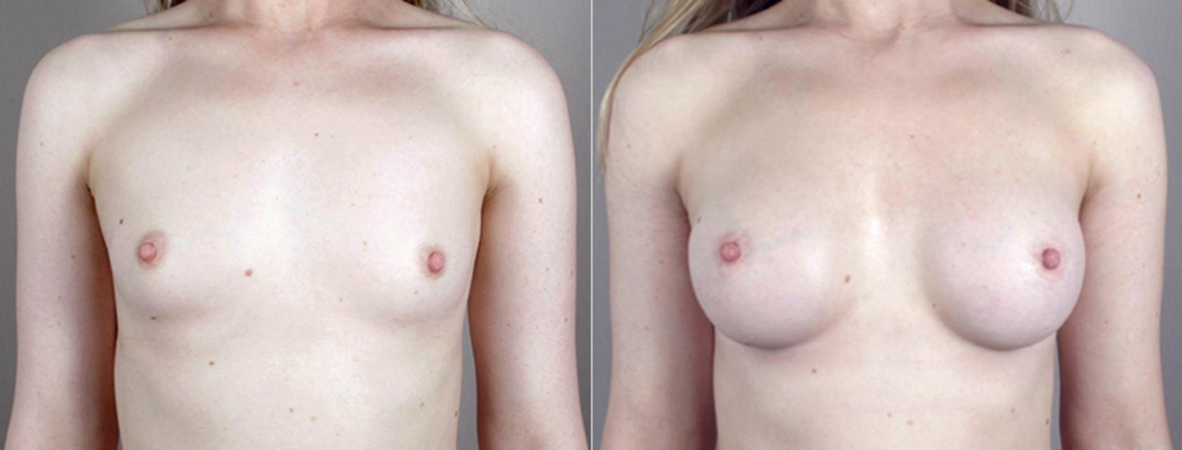 Breast Augmentation Case 392 Before & After View #1 | Paramus, New Jersey | Parker Center for Plastic Surgery