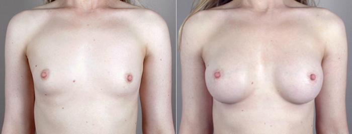 Breast Augmentation Case 392 Before & After View #1 | Paramus, New Jersey | Parker Center for Plastic Surgery