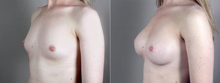 Breast Augmentation Case 392 Before & After View #2 | Paramus, New Jersey | Parker Center for Plastic Surgery