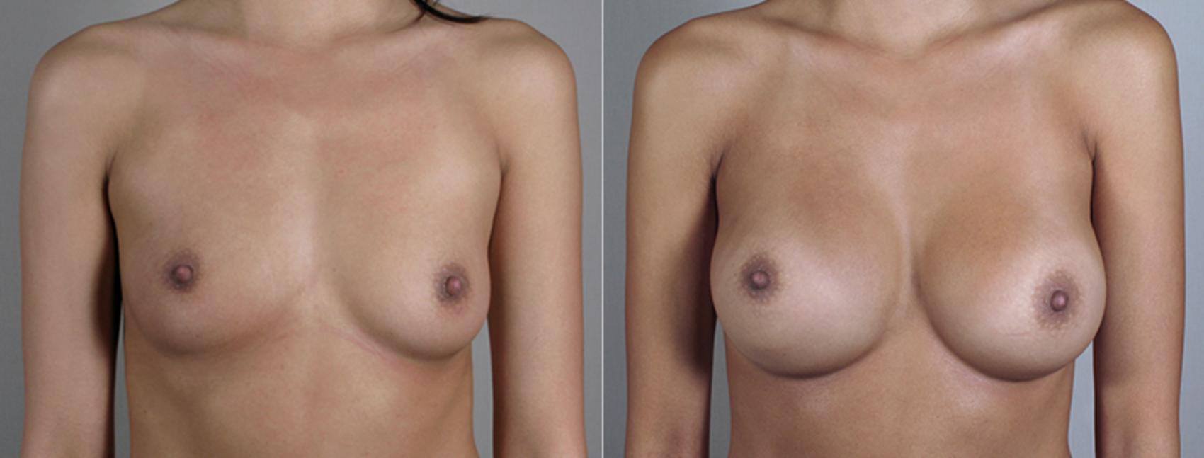 Breast Augmentation Case 393 Before & After View #1 | Paramus, New Jersey | Parker Center for Plastic Surgery