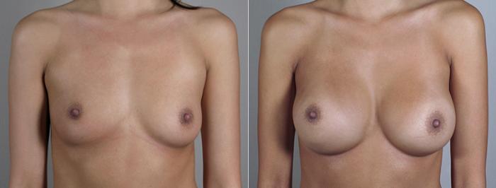 Breast Augmentation Case 393 Before & After View #1 | Paramus, New Jersey | Parker Center for Plastic Surgery